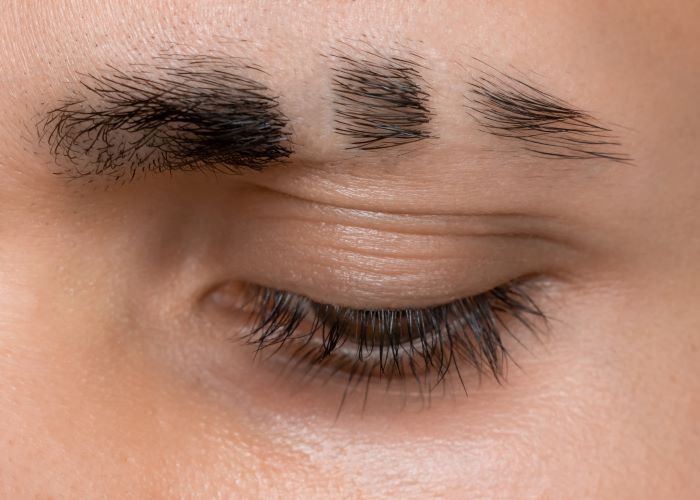 Man with eyebrow scar from mechanical trauma