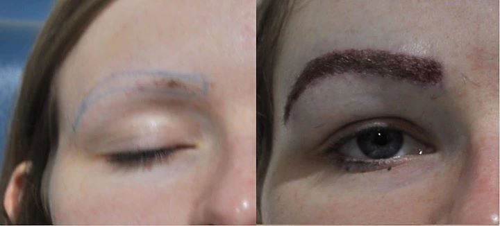 Woman before and after an eyebrow transplant