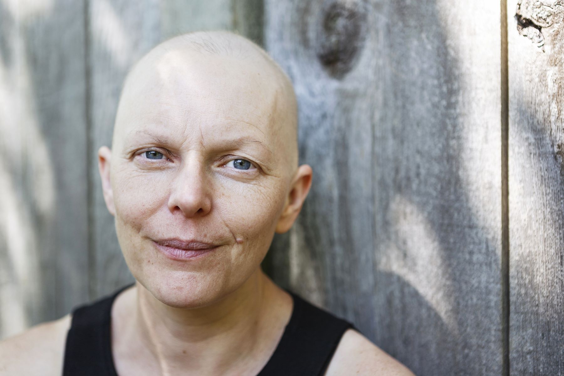 Woman with eyebrow loss from chemotherapy
