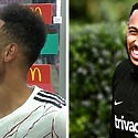 Aubameyang’s Hair Transplant: Was It Surgery Or Spray-on?