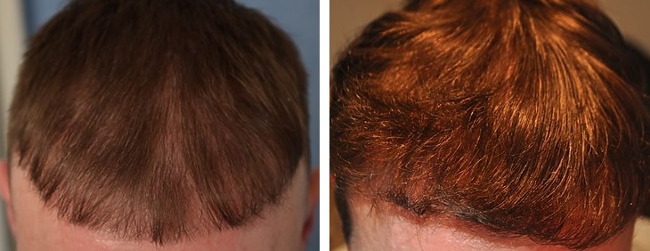 FUE hair transplant after 1 year