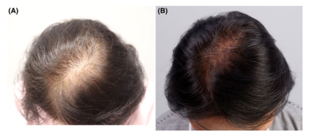 FUE hair transplant for female pattern hair loss