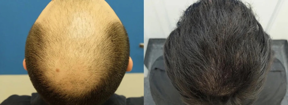 FUE hair transplant for male pattern baldness