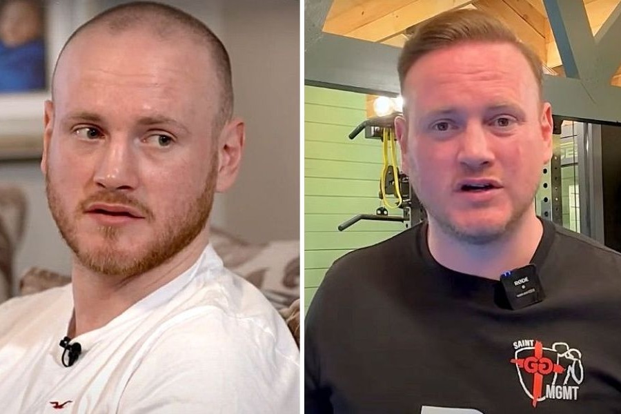 George Groves Before And After Hair Transplant