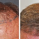 Hair Transplant After 1 Year: Results, Photos, Boosting Growth