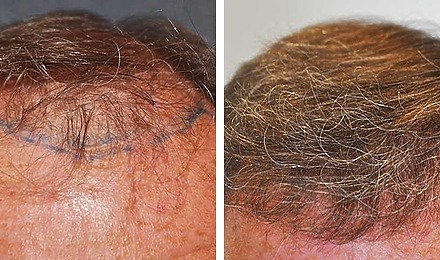 Hair Transplant After 1 Year: Results, Photos, Boosting Growth