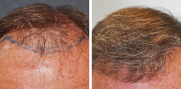 Hair Transplant After 1 Year: Results, Photos, Boosting Growth