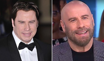 John Travolta’s Hair Transplant: Toupee Or Not Toupee?