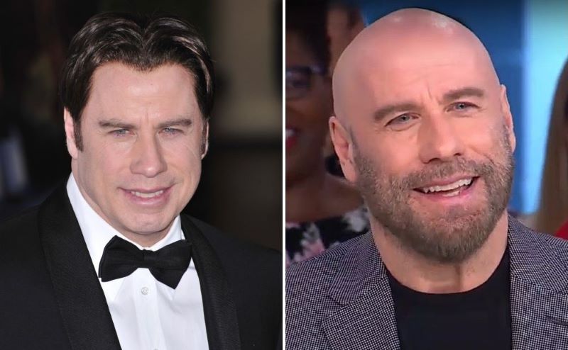 John Travolta’s Hair Transplant: Toupee Or Not Toupee?