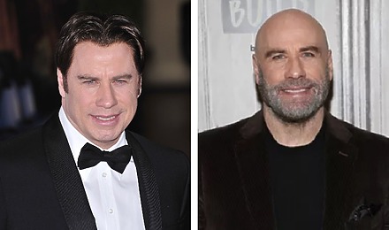 John Travolta’s Hair Transplant: Toupee Or Not Toupee?