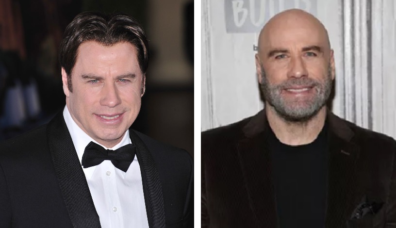 John Travolta’s Hair Transplant: Toupee or not Toupee?