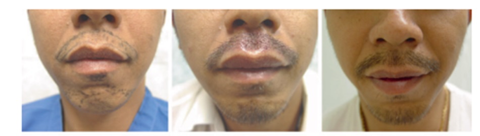 Male patient before and after his moustache transplant