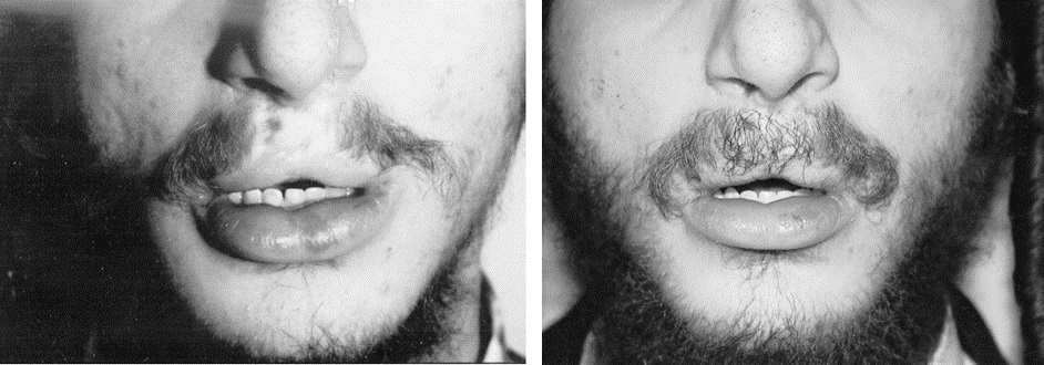 Man before and after a moustache transplant