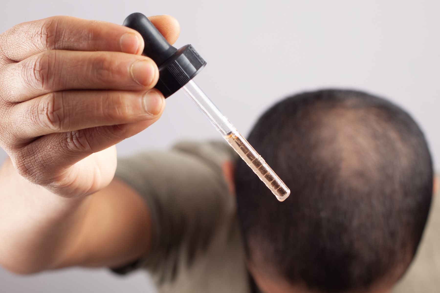 Man using minoxidil for male pattern baldness