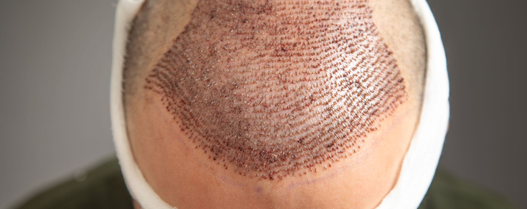 Man waiting for hair to grow after hair transplant