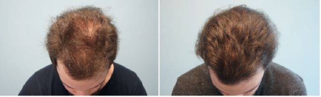 Patient before and 6 months after Minoxidil treatment