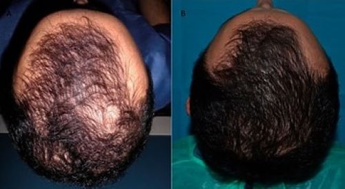 Patient before and after PRP treatment