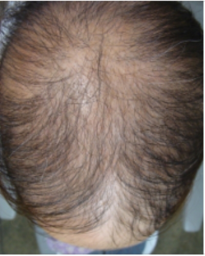 Patient with diffuse alopecia areata