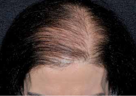 Patient with female pattern baldness