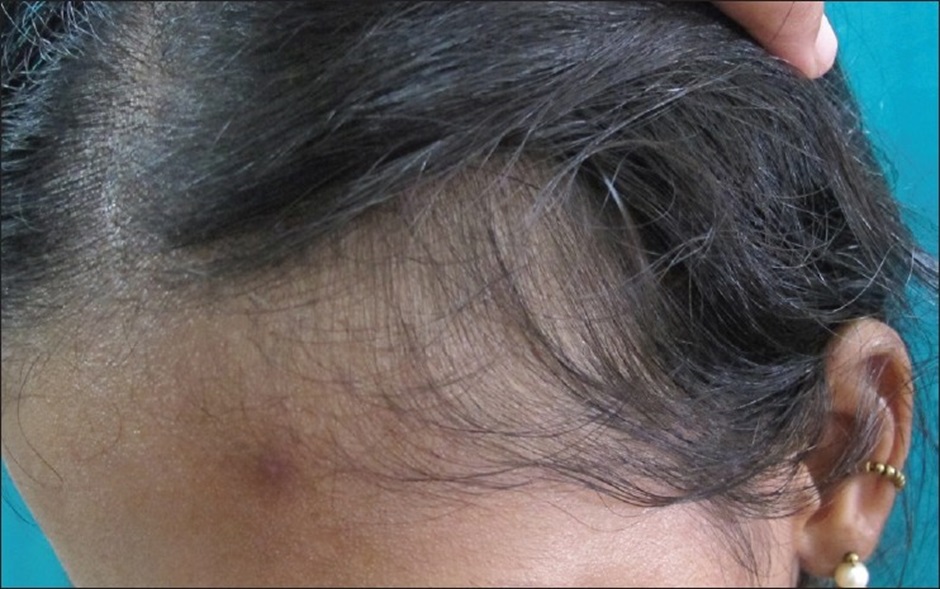 Postpartum hair loss (telogen gravidarium)