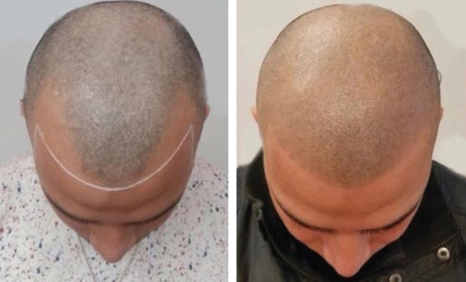 Receding hairline before and after scalp micropigmentation