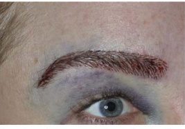 Result of a transgender eyebrow transplant