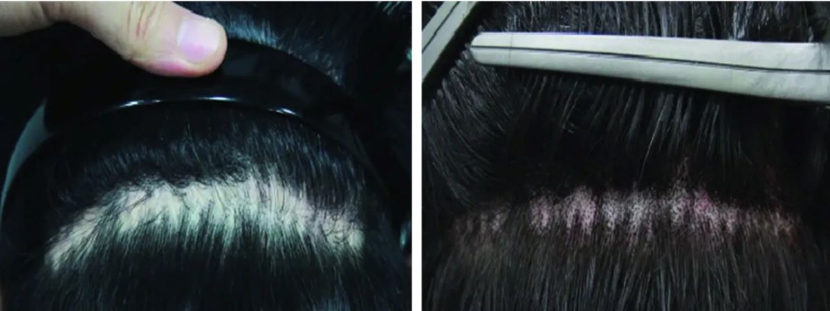 Scalp micropigmentation for FUT hair transplant scar