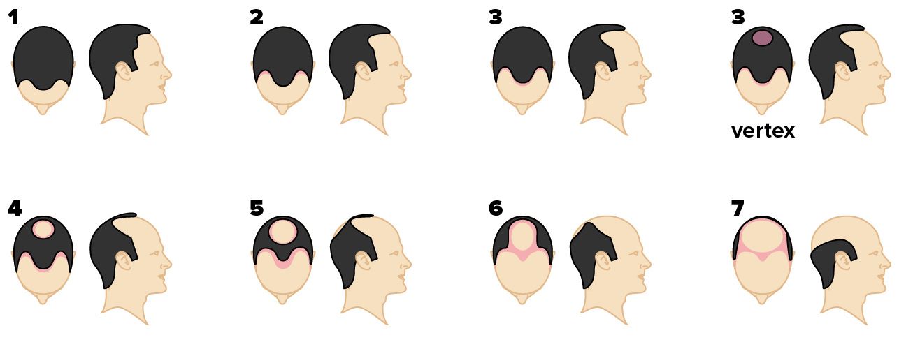 The Norwood Scale for male pattern baldness