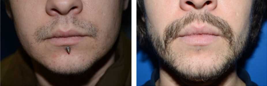 Trans man before and after facial hair transplant