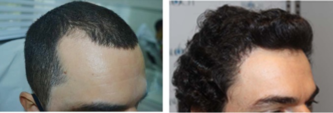 Trans woman before and after hair transplant