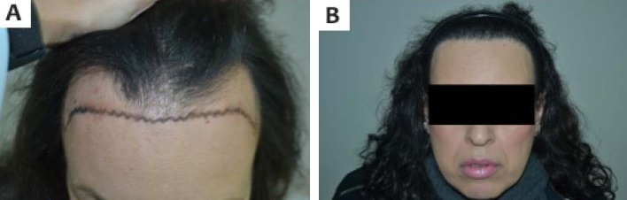 Trans woman before and after temple hair transplant