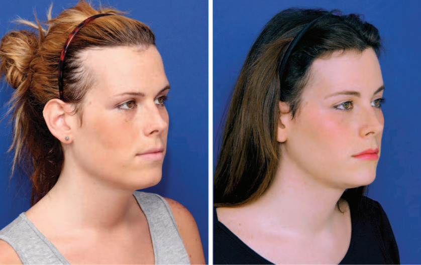 Pubic Hair Transplant: Procedure, Costs, Results, Side Effects - Is Hair Transplant Gender Affirming Care