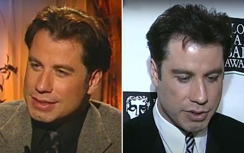 Travolta’s first signs of hair loss