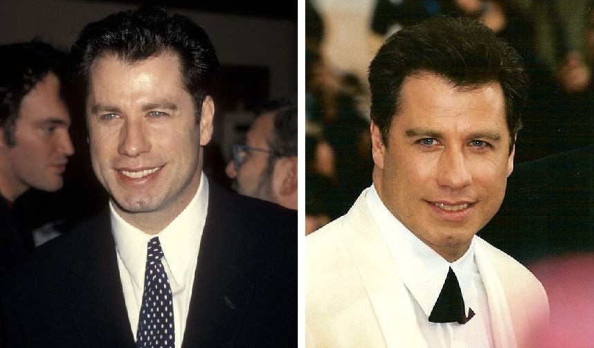 Travolta’s first signs of hair loss