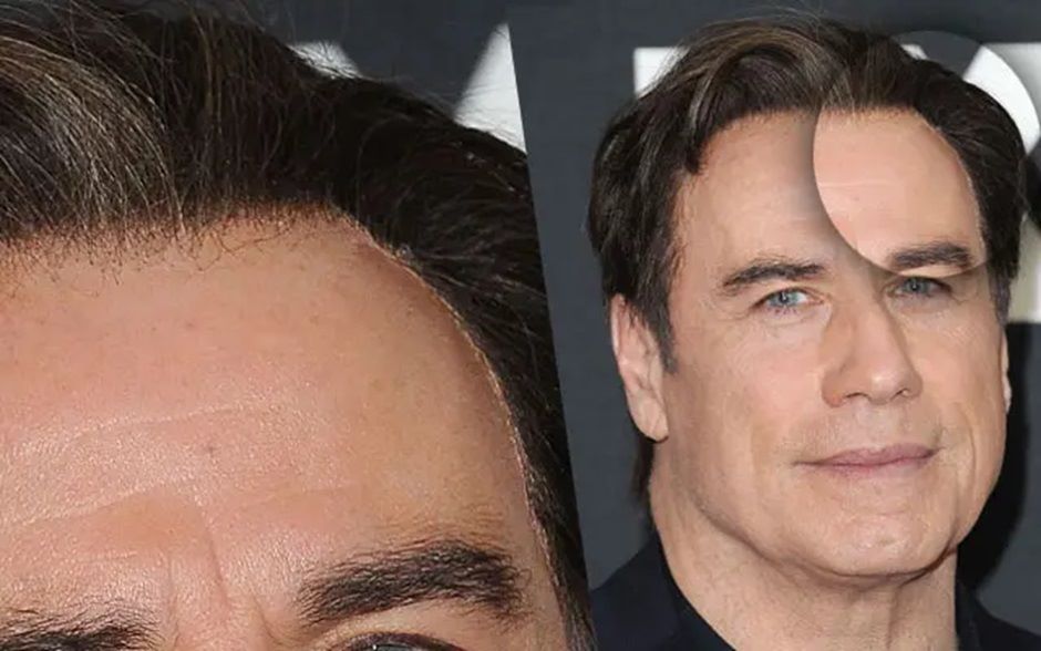 Travolta’s toupee adhesive showing