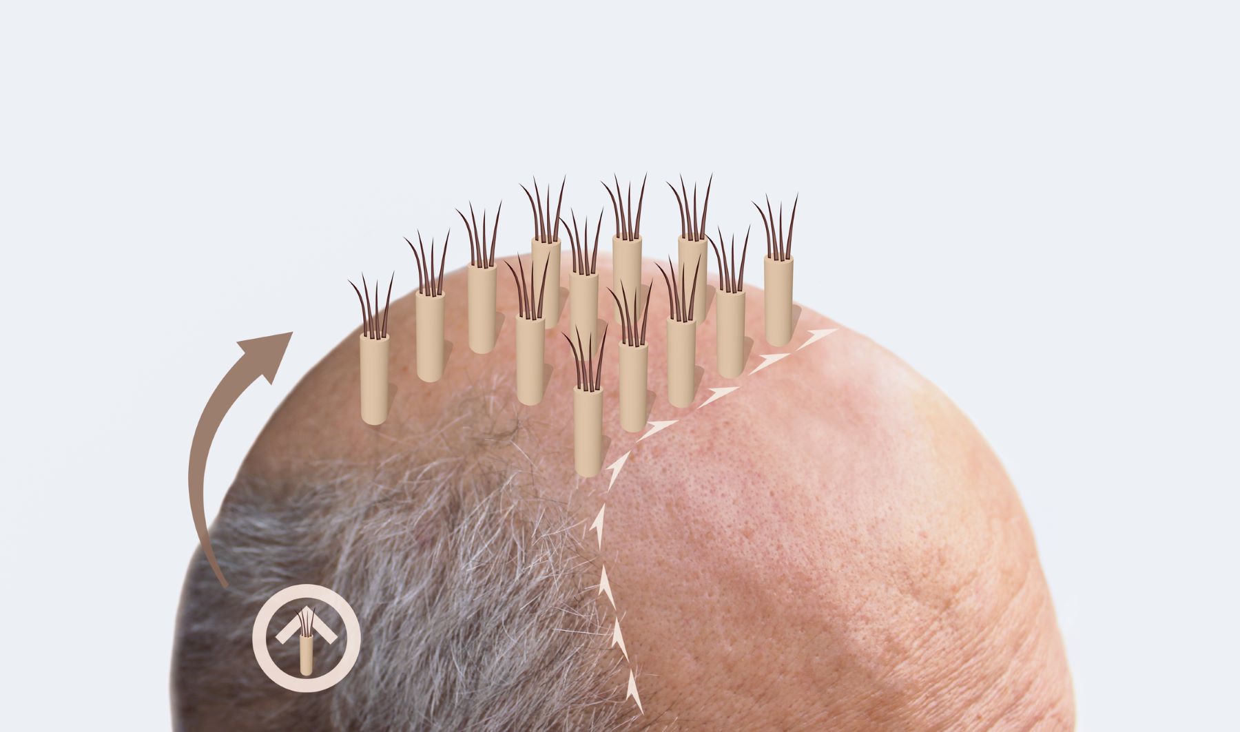 Hair transplant for grey hair