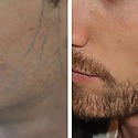 Beard Transplant Timeline: Recovery, Risks And Results