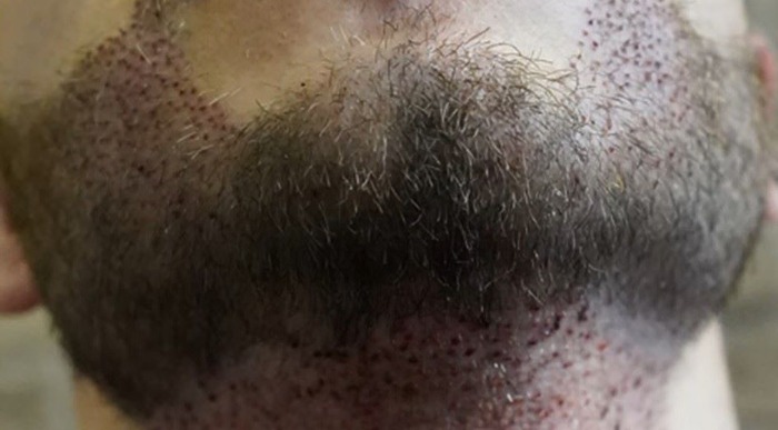 Beard transplant 1 day after the procedure