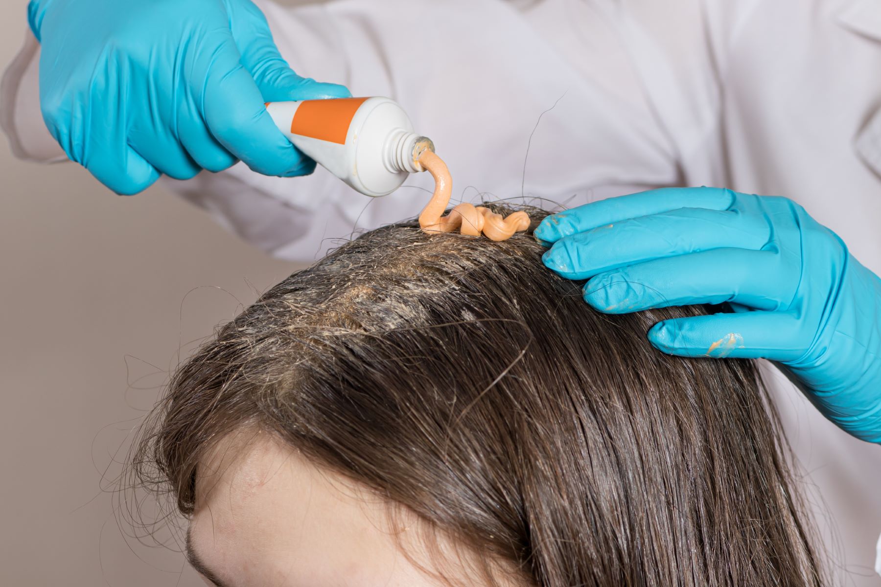 Dermatologist treating patient’s scalp problems