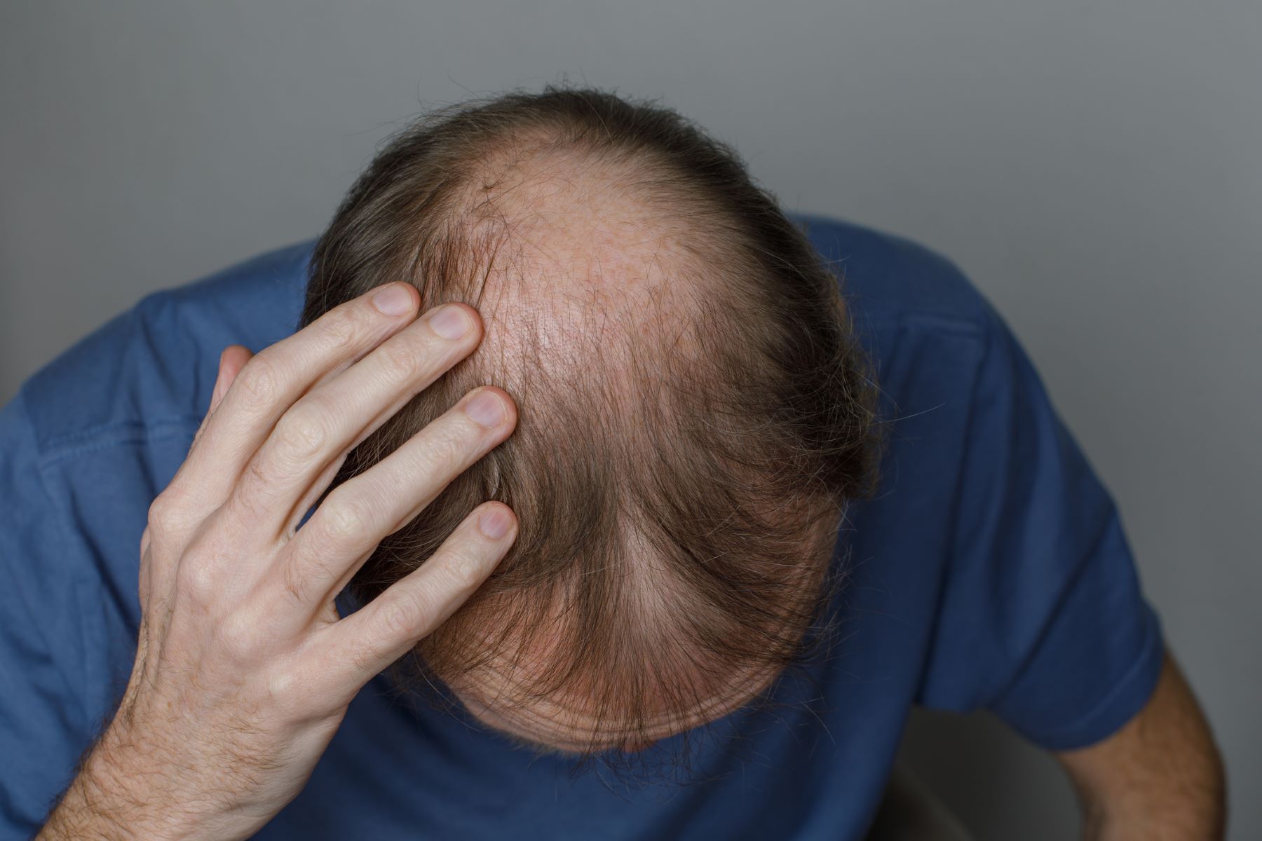 Dutasteride for male pattern baldness