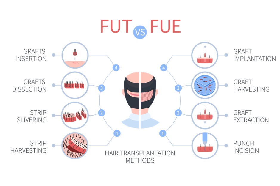 FUE vs. FUT hair transplant