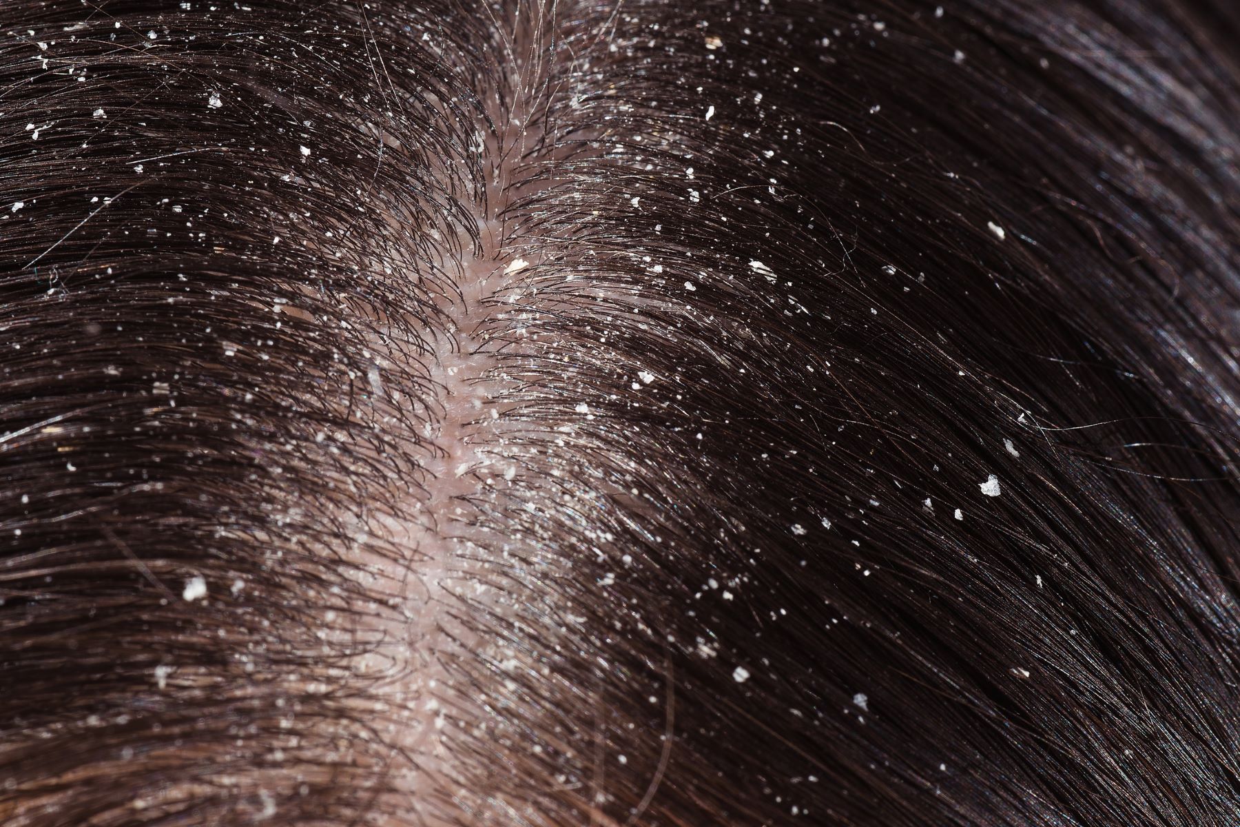 Fungal dandruff in dark hair