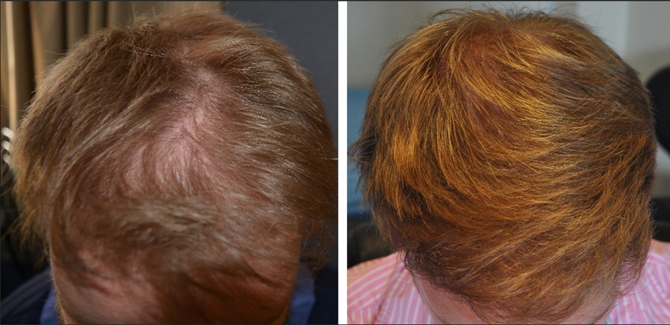 Hair transplant performed at the Wimpole Clinic