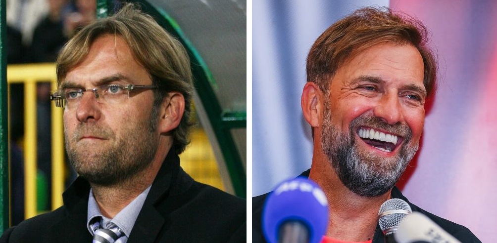 Jurgen Klopp before and after hair transplant