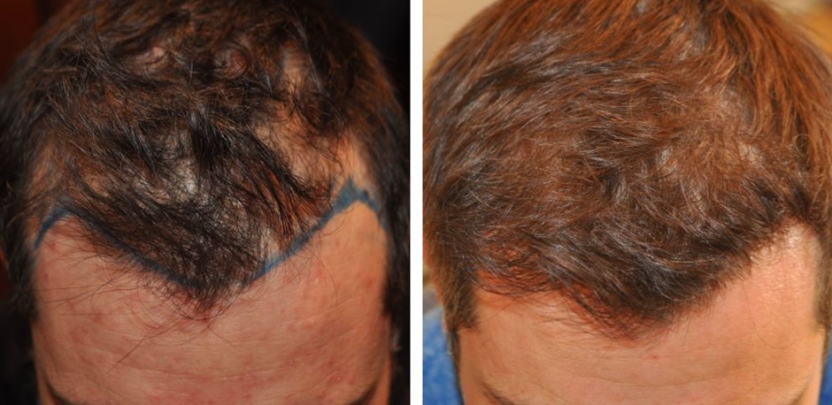 Male hair transplant patient before and after a 2000 graft FUE hair transplant