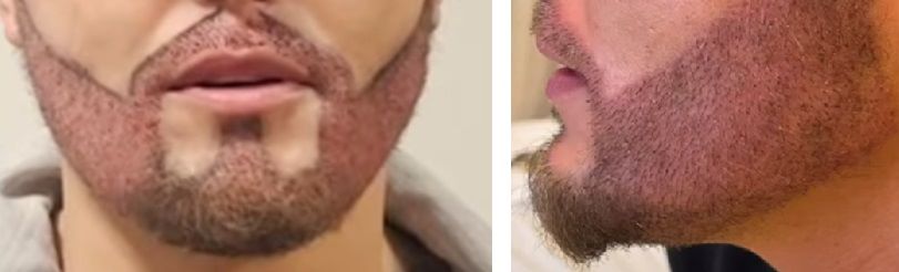 Male patient right after his beard transplant surgery