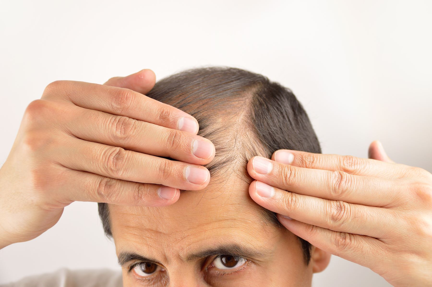 Man whose hair is falling out after PRP treatment