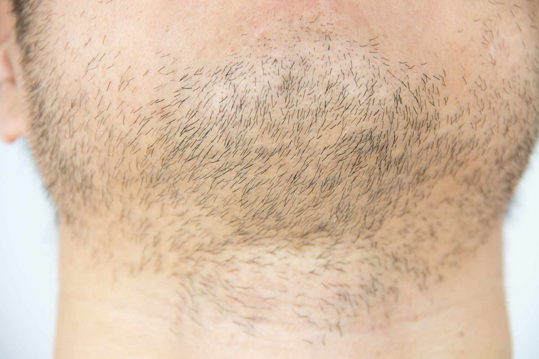 Man with beard telogen effluvium