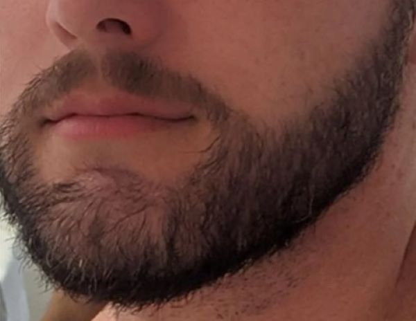 Patient 8 months after his beard transplant