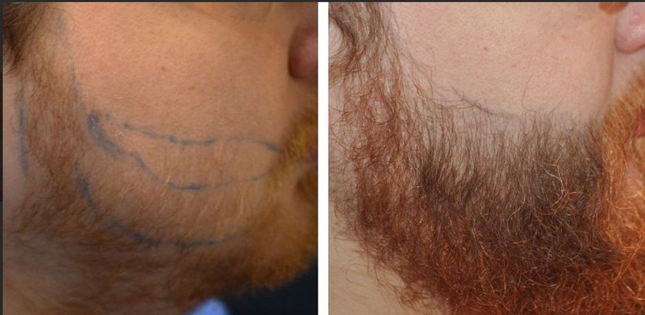 Patient before and 7 months after his beard transplant